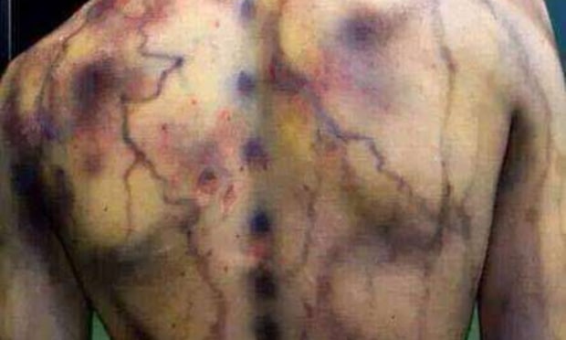 Fájdalom és krónikus fáradtság: 10 jel, ami fibromyalgiára utalhat