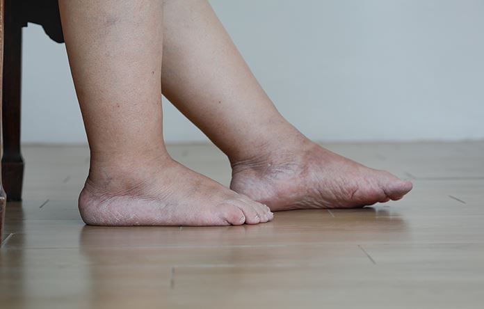 Pied gonflé avec marques de chaussettes visibles