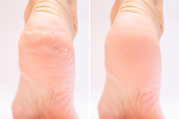 Transformation de pieds secs en pieds doux après soin