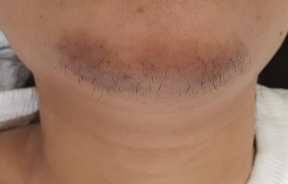 Menton qui se couvre de poils après 50 ans : le verdict d’une dermatologue sur la solution la plus efficace
