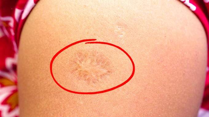 Photo montrant de près la petite cicatrice ronde caractéristique sur un bras.