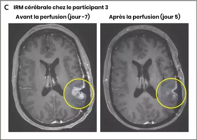 Imagerie médicale montrant une tumeur