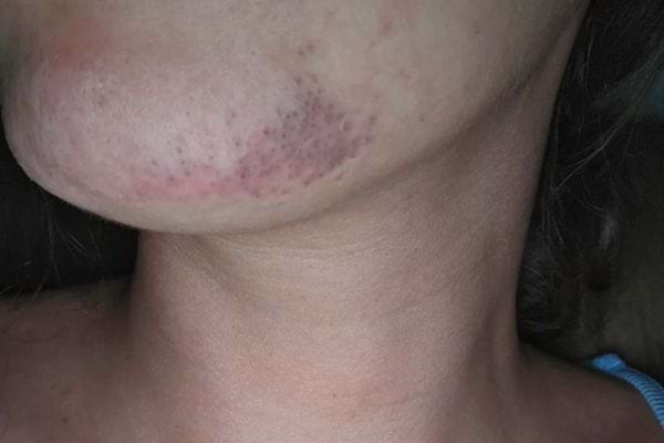 Poils au menton : d'où viennent-ils et que faire ?