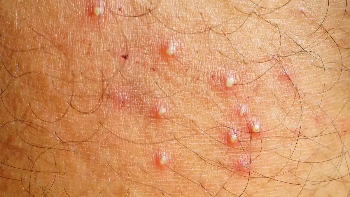 Ces petits points rouges sur votre peau : quand faut-il vraiment s’inquiéter ?