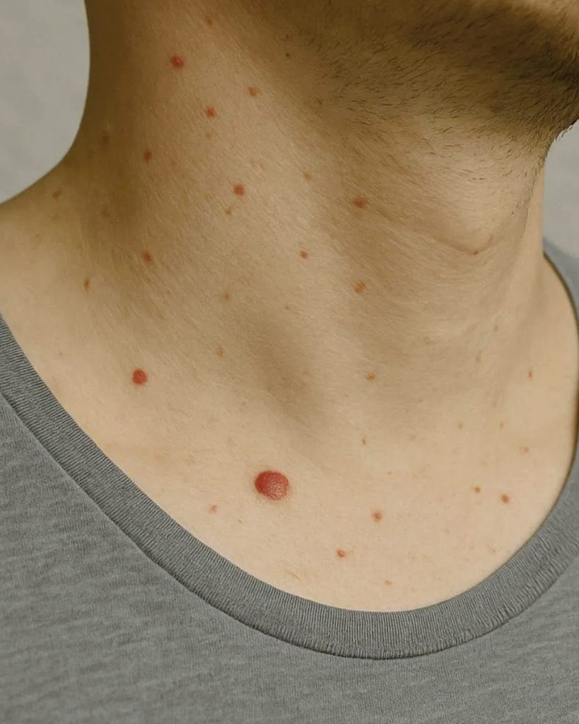 Ces petites taches rouges sur votre peau : tout savoir sur les angiomes ...