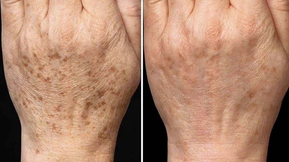 Taches sur les mains : les vraies causes et une recette naturelle pour les estomper