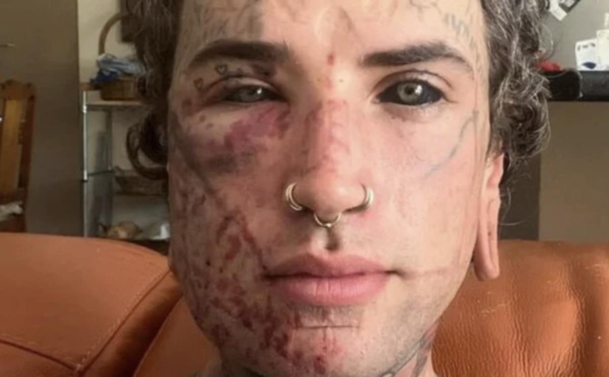 Séance de laser pour l'effacement d'un tatouage sur le visage