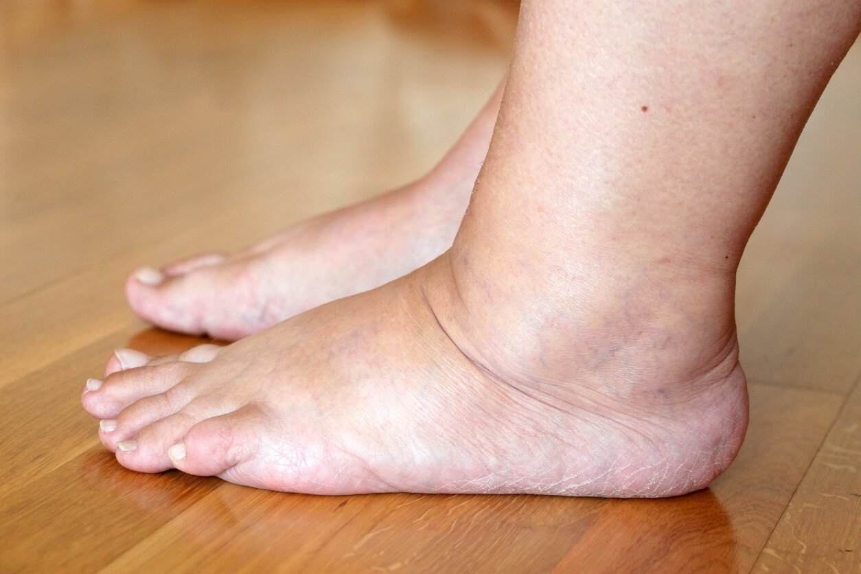 Illustration de jambes gonflées