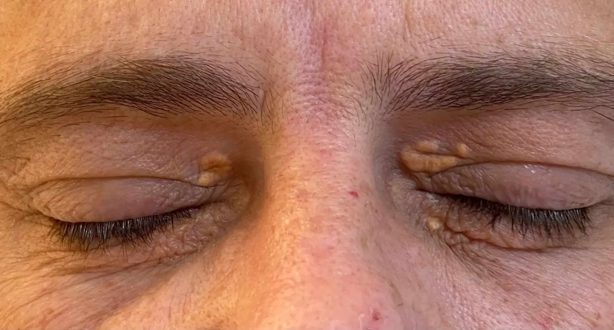 Intervention médicale pour xanthélasma